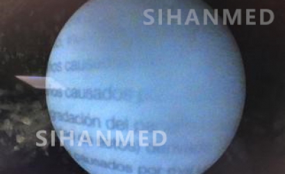 硬性輸尿管鏡的結構及Wolf輸尿管鏡8968.405的維修案例